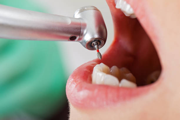 Best Emergency Dental Extractions in Bartonsville, MD